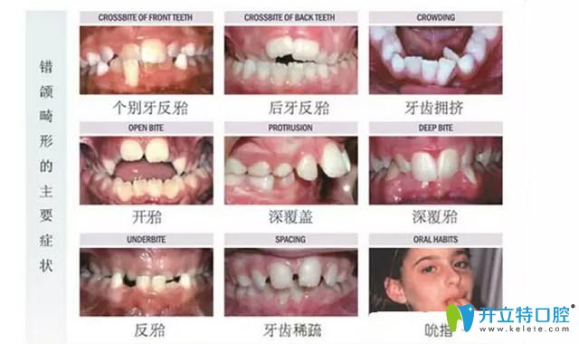 兒童什么樣的牙齒問(wèn)題需要越早矯正越好
