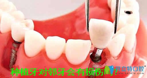 解惑:種植牙對鄰牙會造成損傷嗎?種牙后會導(dǎo)致鄰牙松動嗎?