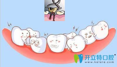 牙齒矯正時(shí)牙列擁擠就需要拔牙