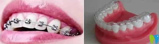 牙齒矯正方法