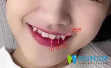 談虎牙矯正好還是拔除好?矯正虎牙(尖牙)價(jià)格是多少錢(qián)？