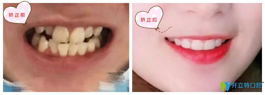 牙齒二次正畸意義大嗎
