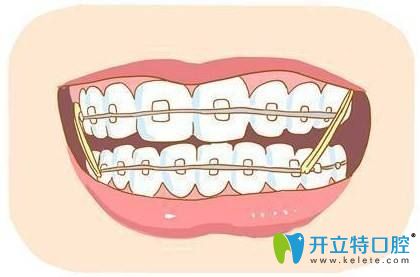 牙齒矯正中容易長蛀牙是真的嗎