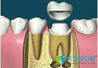 牙齒做過根管治療后需要戴牙冠對其保護