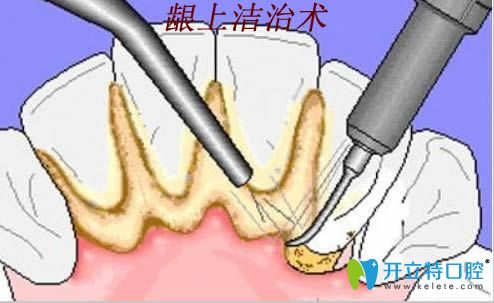 齦上潔治術(shù)治療過(guò)程圖