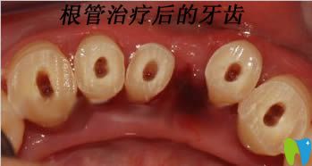 做過根管治療后的牙齒圖