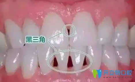 牙齒矯正黑三角圖片