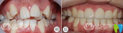 西安優(yōu)德口腔<!--<i data=20240703-sp></i>-->院長隱形矯正案例效果圖