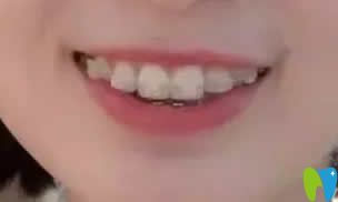 我在西安優(yōu)德口腔戴牙套第8個月變化