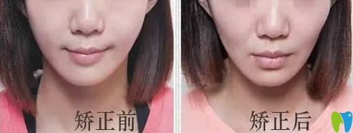 牙套臉會(huì)恢復(fù)嗎