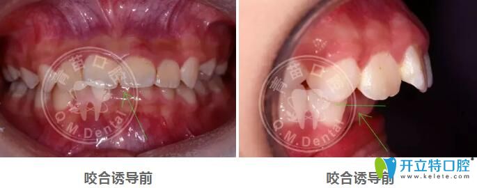 兒童咬合誘導哪家好？深圳青苗口腔羅慕咬合矯正案例驗證