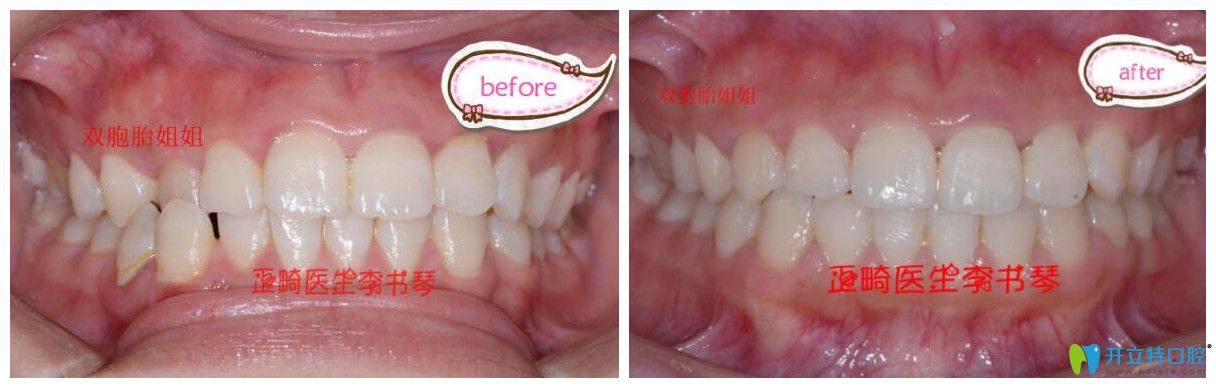 茁悅口腔牙齒錯(cuò)頜畸形矯正案例效果對比