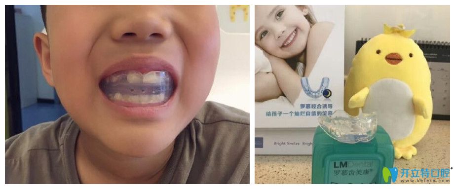 重慶牙齒矯正哪里好？茁悅口腔牙齒正畸案例效果來說明
