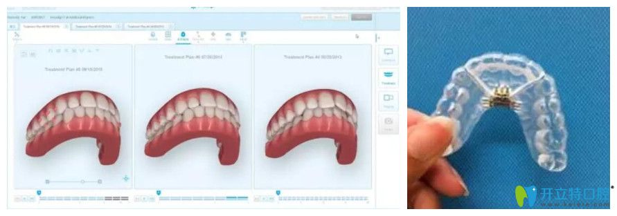  3D掃描后電腦上形成的3D模型及后期咬合微調階段牙套模型