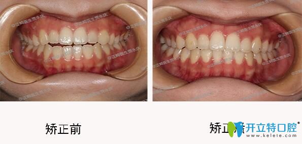 成都口腔哪里正畸好？圣貝口腔牙齒矯正效果來(lái)揭曉