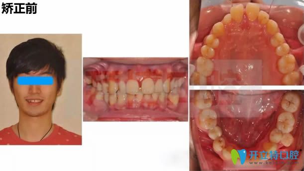 小張?jiān)卩嵵莅莶┛谇蛔鲅例X矯正術(shù)前照