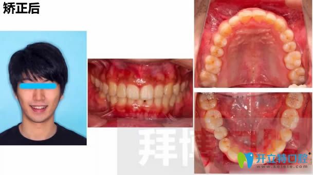 小張?jiān)诎莶┛谇淮餮捞滓荒旰蟮某C正效果