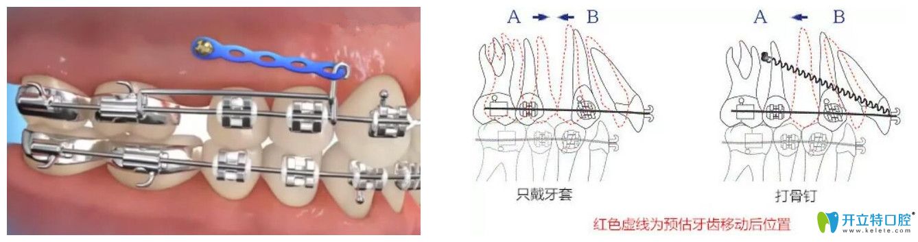 正畸打骨釘疼嗎？牙齒矯正拔骨釘疼不疼