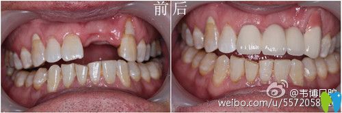 深圳韋博口腔種植牙對(duì)比圖