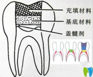 牙齒治療:間接蓋髓術(shù)和直接蓋髓術(shù)的區(qū)別及適應(yīng)癥匯總