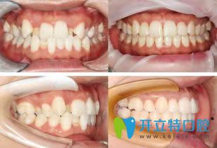 張瑩鴿牙齒正畸案例效果對(duì)比圖