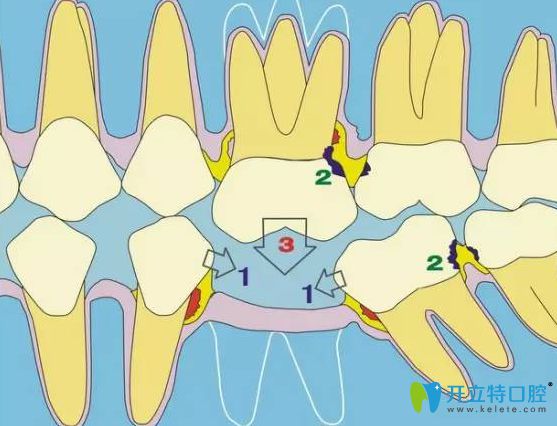 拔牙會導(dǎo)致旁邊的牙齒松動嗎?流傳年輕人不能拔牙是真的嗎