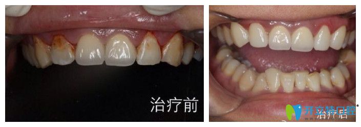 <!--<i data=20240703-sp></i>-->口腔趙中華怎么樣？來看真人案例效果