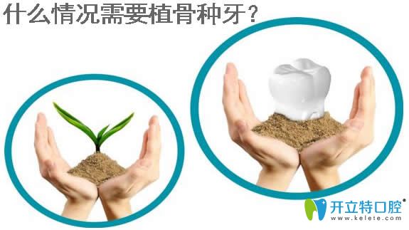 什么情況需要植骨種牙