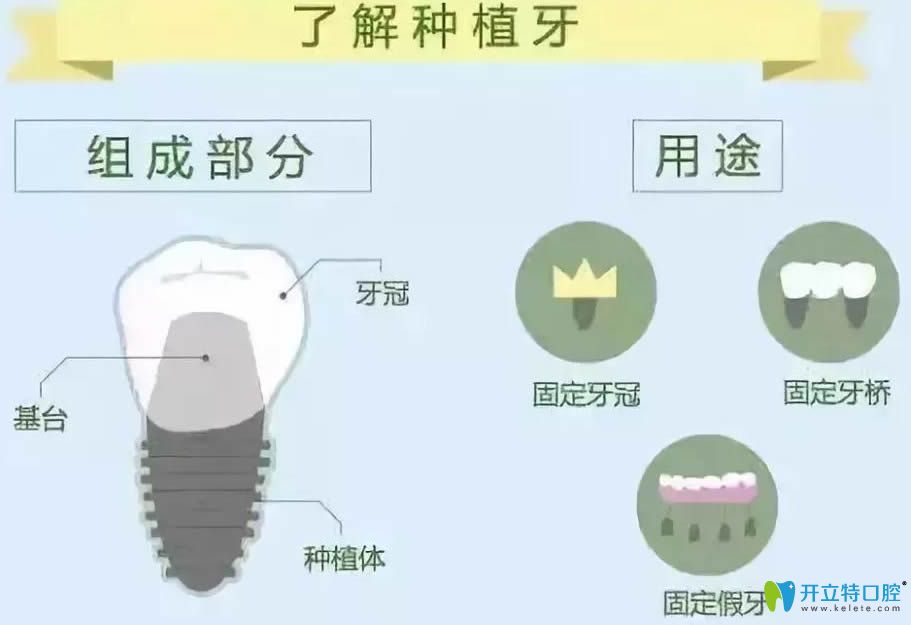 看了全口種植牙價(jià)格表 驚訝種植牙為什么那么貴是行業(yè)暴利?
