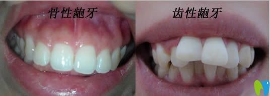 骨性齙牙和齒性齙牙癥狀圖片