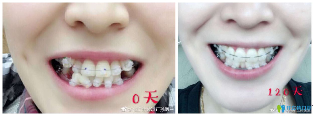 北京中諾口腔劉興華正畸怎么樣？案例效果來驗證