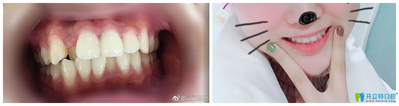 北京中諾口腔孫金鑫牙齒矯正好不好？案例效果來證明