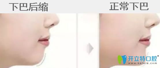 下巴后縮帶牙套有用嗎？真相揭秘下巴后縮矯正后堪比整容