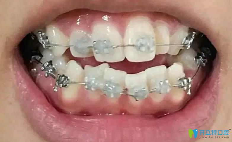 真心覺(jué)得在長(zhǎng)春欣雅口腔做的牙齒矯正價(jià)格不貴且效果好
