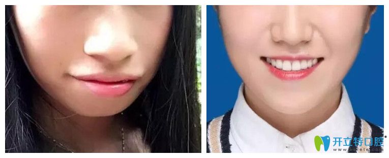 牙齒正畸對臉型的影響？看牙齒矯正案例效果前后對比圖