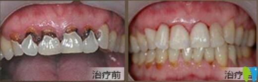 北京中諾口腔好不好？郭祖迎牙齒修復(fù)案例效果來(lái)驗(yàn)證