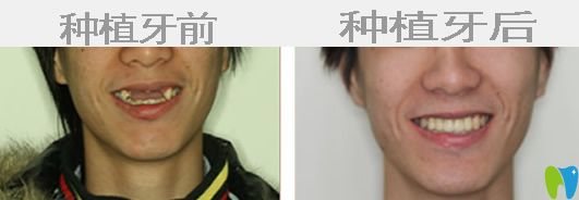種植牙前后對(duì)比圖