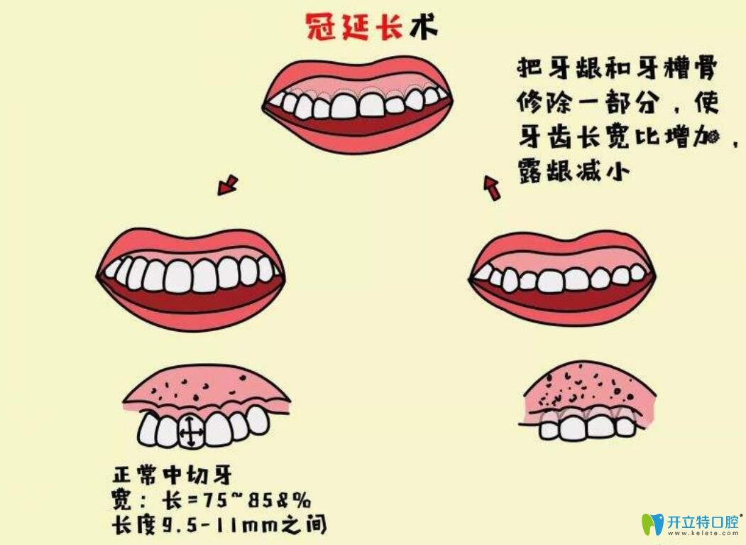 牙冠延長術(shù)是什么，有什么作用