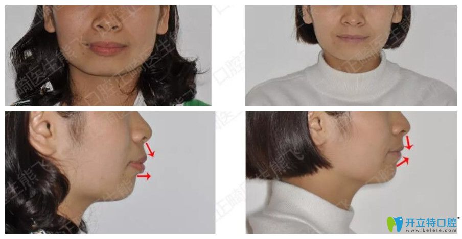 圣貝口腔正畸怎么樣？來看熊飛突嘴齙牙矯正案例前后效果對比