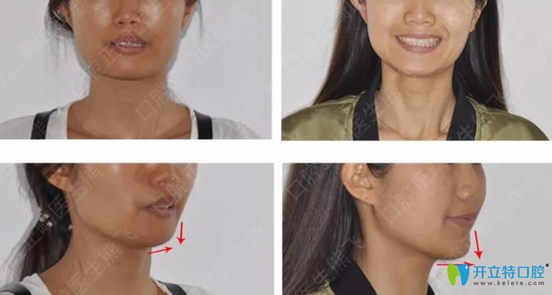 廣州圣貝口腔怎么樣？公布熊飛等醫(yī)生牙齒矯正案例