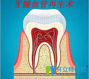 何為牙髓血管再生術(shù)?年輕恒牙血管再生的適應(yīng)癥和優(yōu)勢介紹
