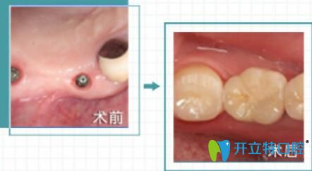 福州哪家種植牙好？維樂口腔陳獻(xiàn)禮院長(zhǎng)即刻種植案例來(lái)驗(yàn)證