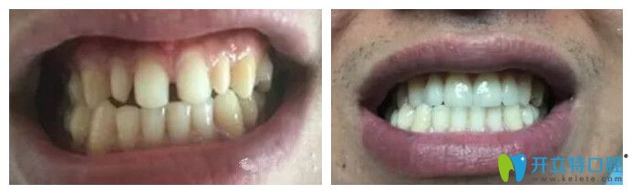 北京中諾口腔劉曉清怎么樣？來看瓷貼面修復(fù)牙齒案例效果