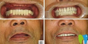 水激光種植牙技術(shù)前后對(duì)比圖
