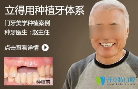 北京中諾趙振宇種植牙怎么樣？案例及顧客反饋來(lái)看
