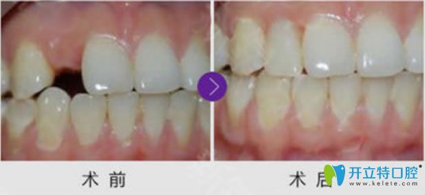 洛陽拜博口腔單顆牙缺失種植牙前后對(duì)比效果