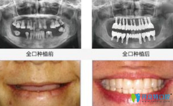 全口種植牙前后對比圖