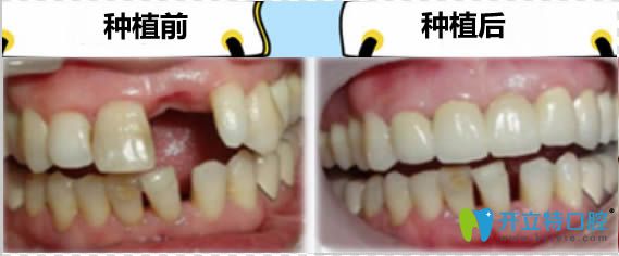 瑞士iti親水種植牙前后對(duì)比效果