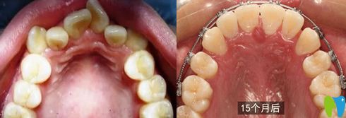 牙周炎正畸成功案例