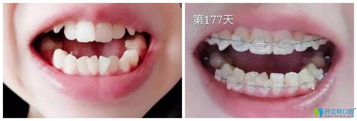 在漢中小白象口腔做牙齒矯正前和177天對比圖牙齒矯正前和177天對比圖片